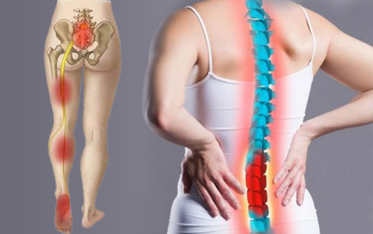 Đau thần kinh tọa: Nguyên nhân, triệu chứng, chẩn đoán và cách điều trị